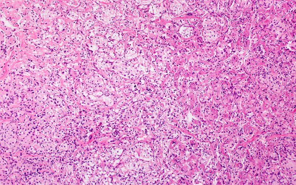 25B3 Meningioma, clear cell & Whorling Sclerosing (Case 25) H&E 10X