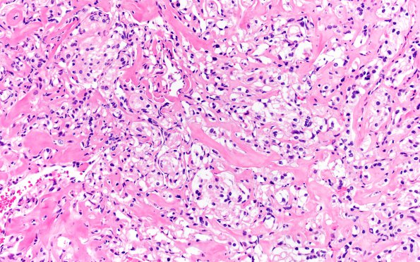 25B4 Meningioma, clear cell & Whorling Sclerosing (Case 25) H&E 20X 2