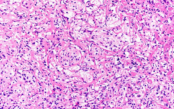 25B5 Meningioma, clear cell & Whorling Sclerosing (Case 25) H&E 20X