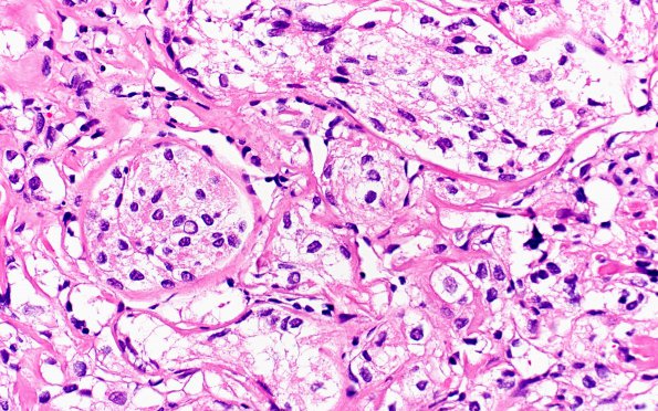 25B6 Meningioma, clear cell & Whorling Sclerosing (Case 25) H&E 40X 2