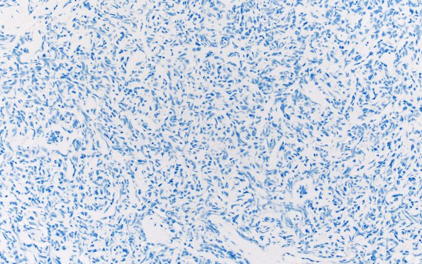 25C1 Meningioma, clear cell & Whorling Sclerosing (Case 25) EMA 20X