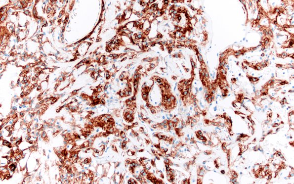 25D1 Meningioma, clear cell & Whorling Sclerosing (Case 25) SSTR2 20X 2