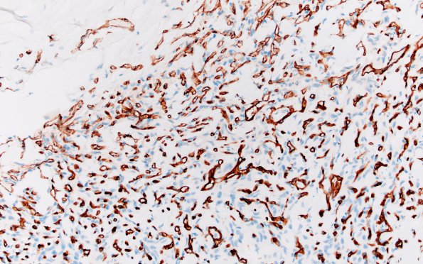 25E1 Meningioma, clear cell & Whorling Sclerosing (Case 25) CD31 20X