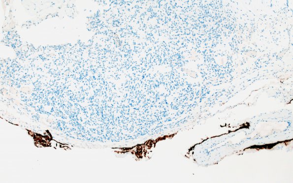 25F Meningioma, clear cell & Whorling Sclerosing (Case 25) GFAP 10X2