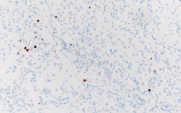 25G1 Meningioma, clear cell & Whorling Sclerosing (Case 25) Ki67 20X