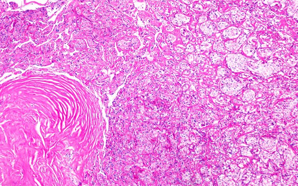 25H1 Meningioma, clear cell & Whorling Sclerosing (Case 25) PAS noD 10X