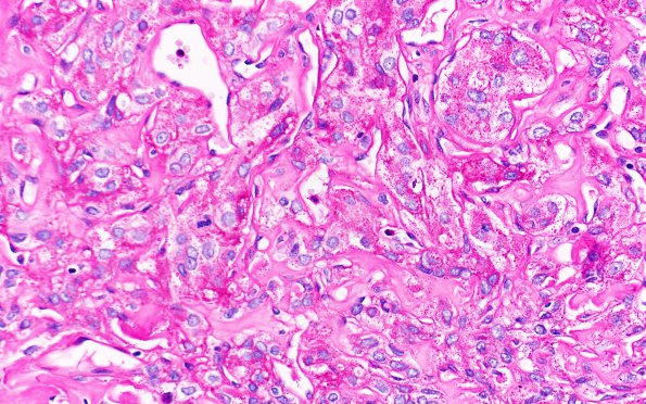 25H2 Meningioma, clear cell & Whorling Sclerosing (Case 25) PAS noD 40X 2