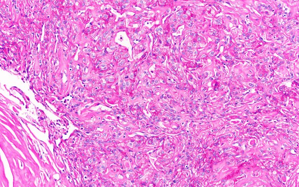 25H3 Meningioma, clear cell & Whorling Sclerosing (Case 25) PAS noD 20X 1