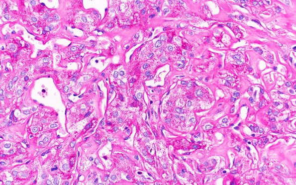 25H4 Meningioma, clear cell & Whorling Sclerosing (Case 25) PAS noD 40X 4