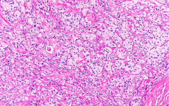 25K1 Meningioma, clear cell & Whorling Sclerosing (Case 25) PAS with D 10X 3