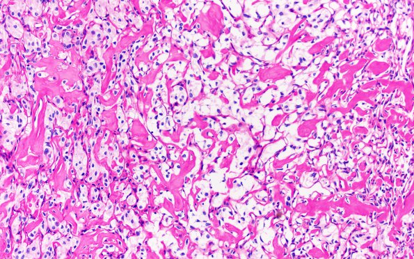 25K2 Meningioma, clear cell & Whorling Sclerosing (Case 25) PAS&Diastase 20X 2