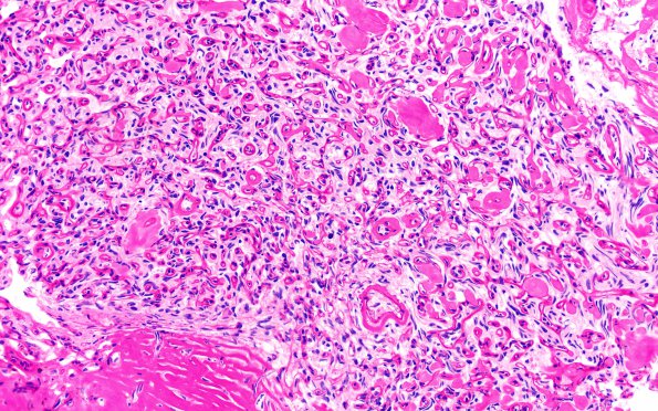 25K3 Meningioma, clear cell & Whorling Sclerosing (Case 25) PAS&Diastase 20X 1