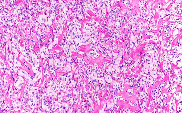 25K4 Meningioma, clear cell & Whorling Sclerosing (Case 25) PAS&Diastase 20X 3