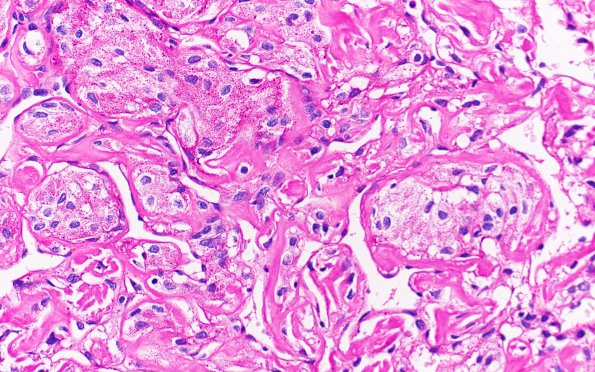 25L1 Same area with NO Diastase (Case 25) 40X