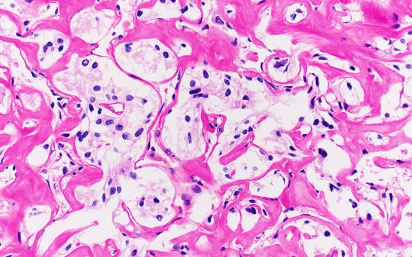 25L2 Same area with Diastase (Case 25) 40X 3