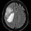 2A1 Meningioma, clear cell (Case 2) FLAIR - Copy