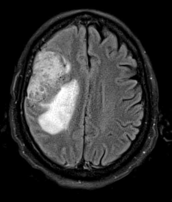 2A1 Meningioma, clear cell (Case 2) FLAIR - Copy