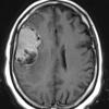 2A2 Meningioma, clear cell (Case 2) T1 W 4 - Copy