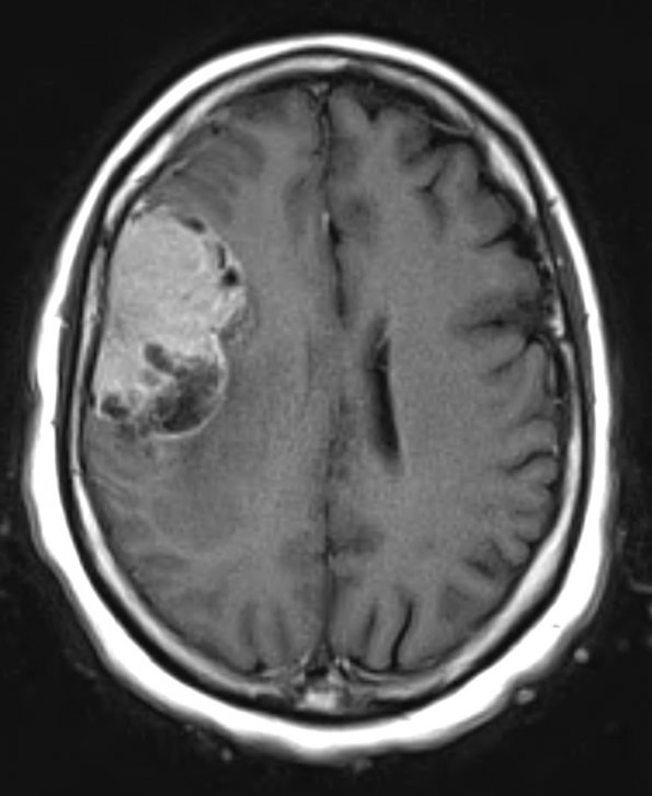 2A2 Meningioma, clear cell (Case 2) T1 W 4 - Copy