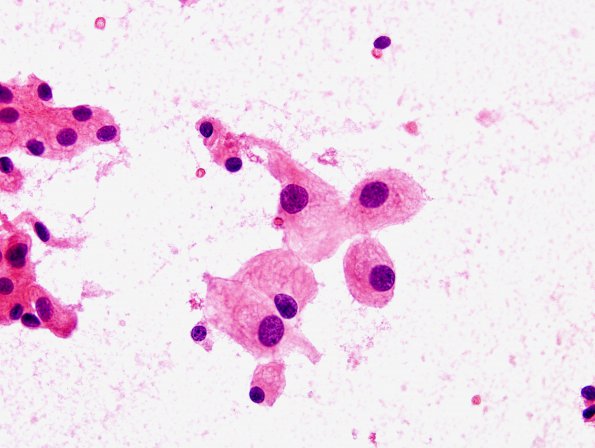 2B1 Meningioma, clear cell (Case 2) Smear 3