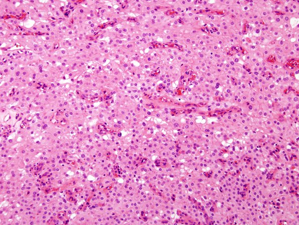 2B2 Meningioma, clear cell (Case 2) H&E 3