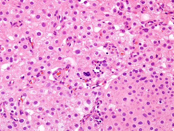 2B3 Meningioma, clear cell (Case 2) H&E 10