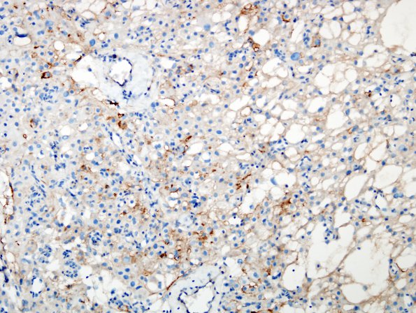 2C1 Meningioma, clear cell (Case 2) EMA 4