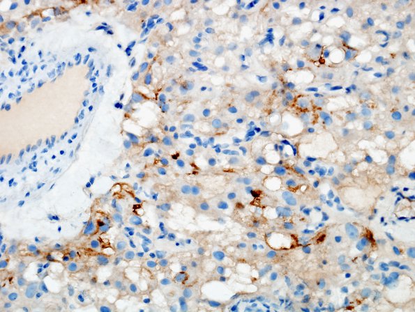 2C2 Meningioma, clear cell (Case 2) EMA 2