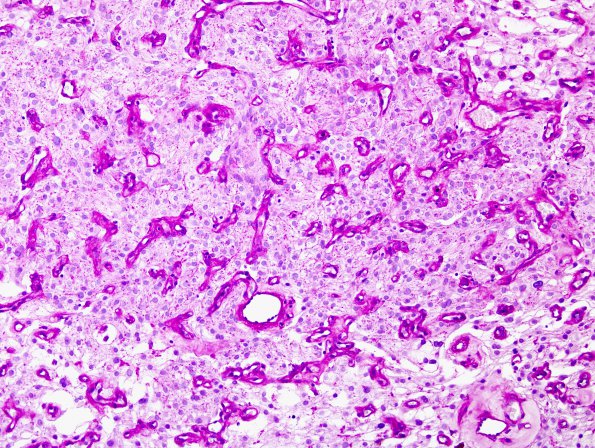 2E2 Meningioma, clear cell (Case 2) PAS no diastase 5