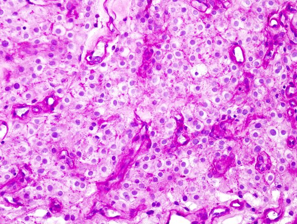 2E3 Meningioma, clear cell (Case 2) PAS no diastase 6