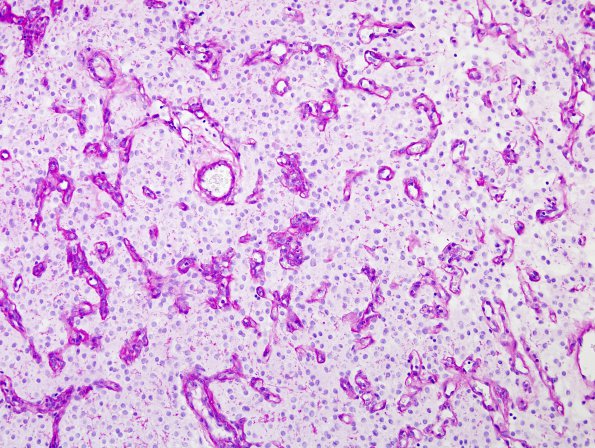 2F1 Meningioma, clear cell (Case 2) PAS with diastase 1