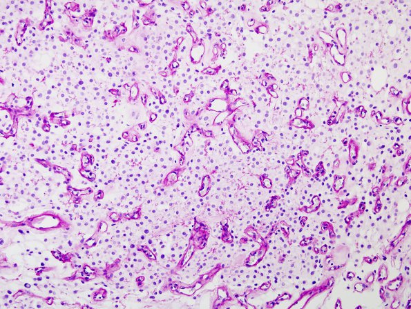 2F2 Meningioma, clear cell (Case 2) PAS with diastase 3