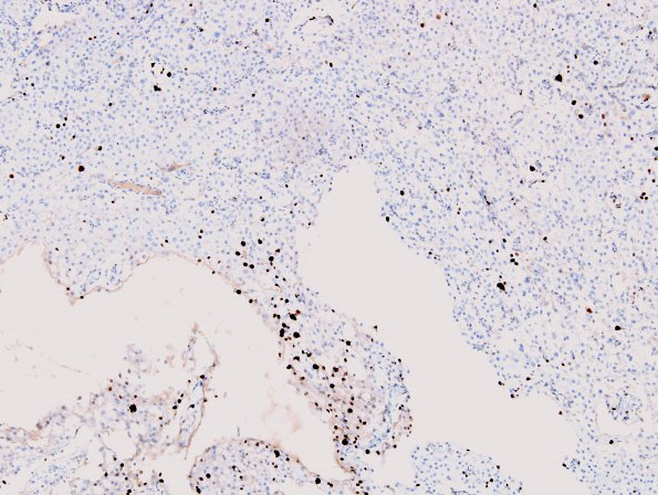 2G Meningioma, clear cell (Case 2) MIB