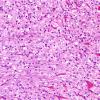 3A1 Meningioma, clear cell type (Case 3) H&E a