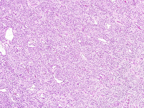 4A1 Meningioma, clear cell (Case 4) H&E 6