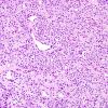 4A2 Meningioma, clear cell (Case 4) H&E 5