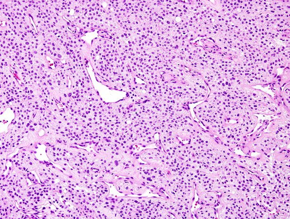 4A2 Meningioma, clear cell (Case 4) H&E 5