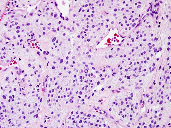 4A3 Meningioma, clear cell (Case 4) H&E 4