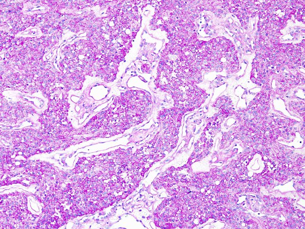 4C1 Meningioma, clear cell (Case 4) PAS 3