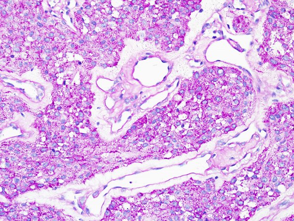 4C2 Meningioma, clear cell (Case 4) PAS 2