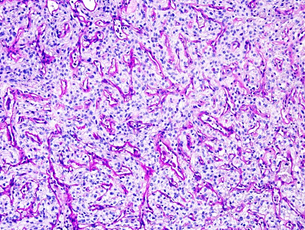 4D1 Meningioma, clear cell (Case 4) PAS w diastase 2