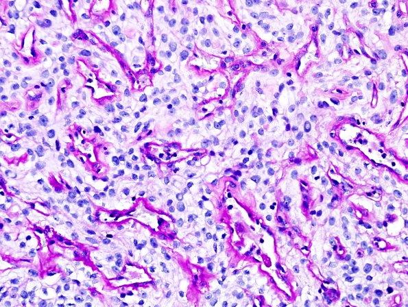 4D2 Meningioma, clear cell (Case 4) PAS W diastase 1