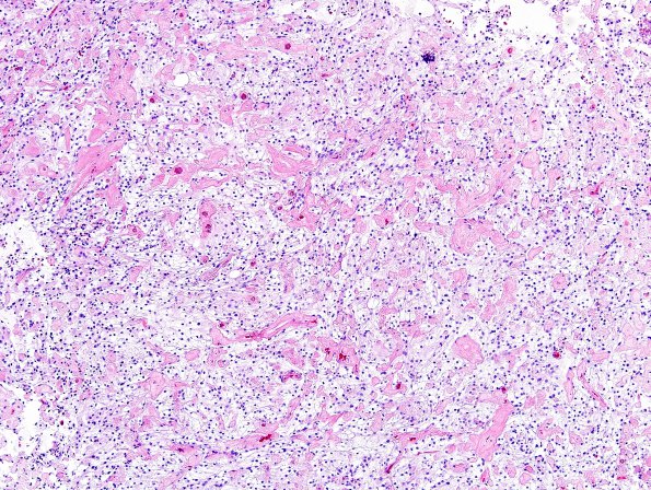 5A1 Meningioma, clear cell (Case 5) H&E 4