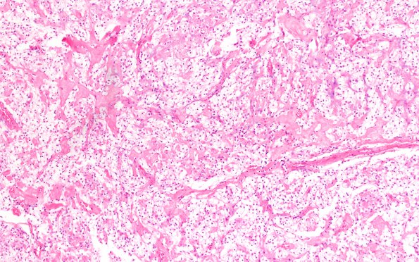 5A2 Meningioma, clear cell (Case 5) H&E 10X