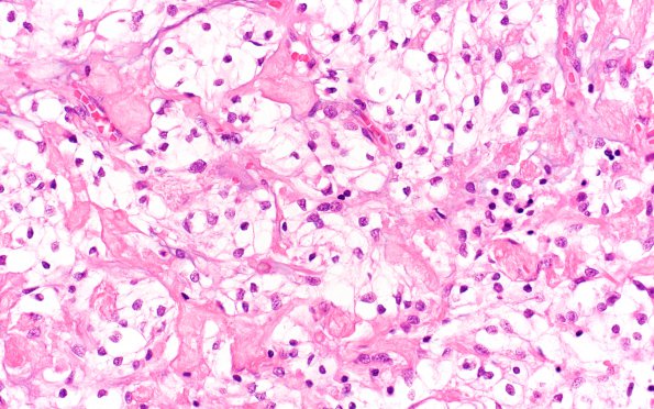 5A3 Meningioma, clear cell (Case 5) H&E 40X