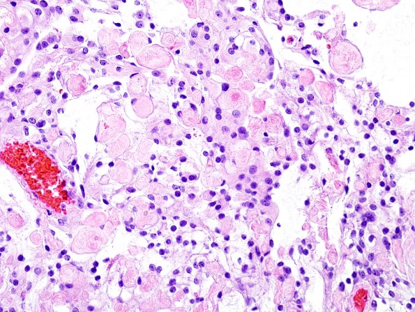 5A4 Meningioma, clear cell (Case 5) H&E 1