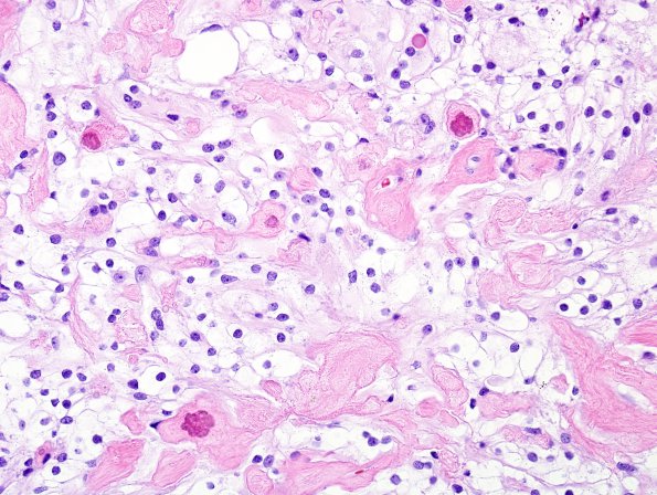 5A5 Meningioma, clear cell (Case 5) H&E 5