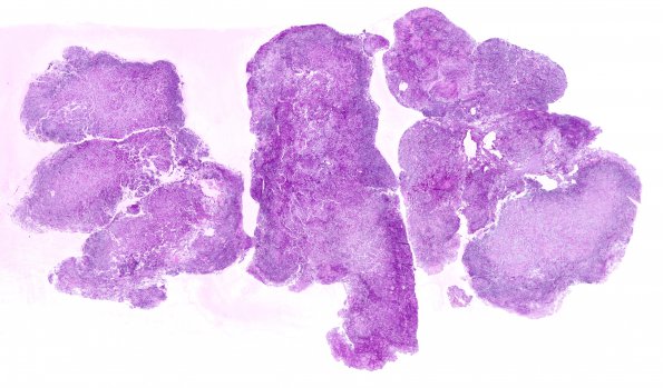 5B1 Meningioma, clear cell (Case 5) PAS Without Diastase WM