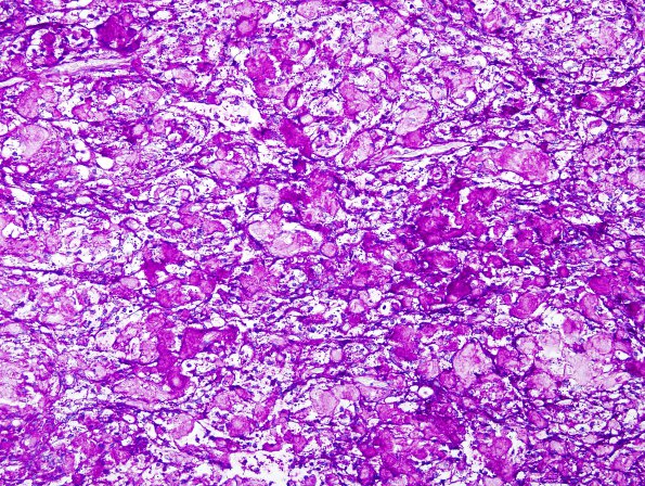 5B2 Meningioma, clear cell (Case 5) PAS Without Diastase 2