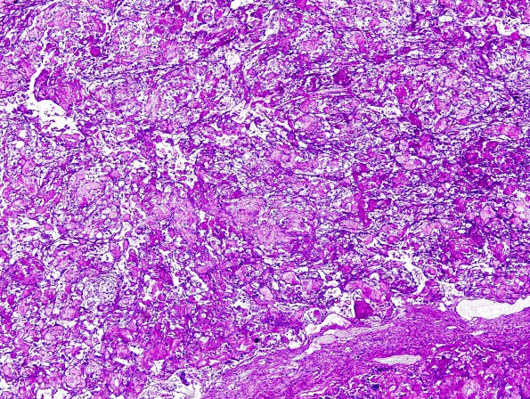 5B3 Meningioma, clear cell (Case 5) PAS Without Diastase 3